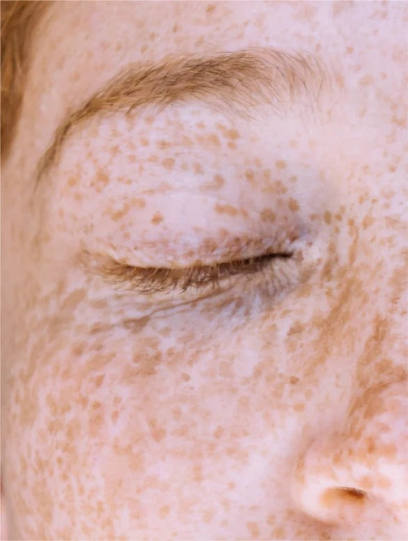 Close-up of a person's eye with visible freckles on the skin.