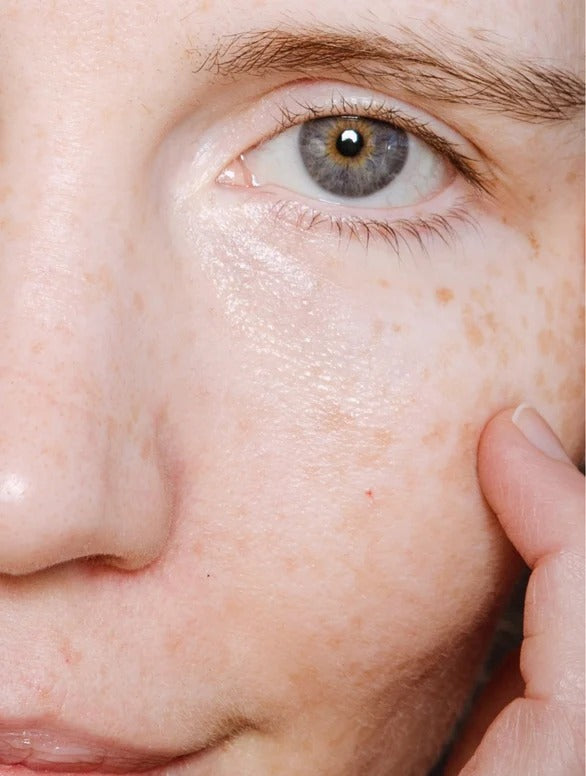 Close-up of a person's eye with visible freckles on their face using Revliss Peptide Serum